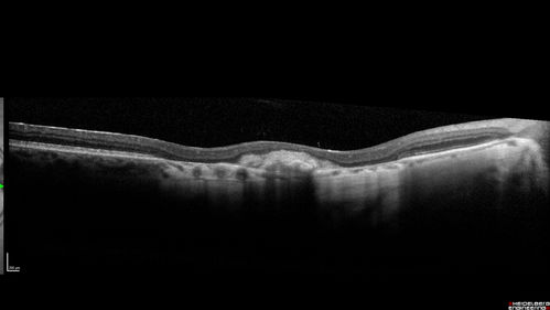 Macular Scars - Laser (1980s) Ocular Histoplasmosis
70 year old man who had laser at Wills, Wilmer and the Mayo clinic before better therapies were available for ocular histoplasmosis related CNVM
