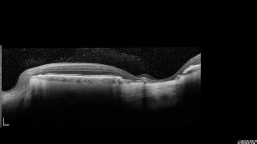 Macular Scars - Laser (1980s) Ocular Histoplasmosis
70 year old man who had laser at Wills, Wilmer and the Mayo clinic before better therapies were available for ocular histoplasmosis related CNVM
