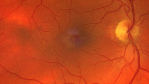 Macular Telangetasia MacTel - Nonproliferative
60 year old non-diabetic female with gradual vision loss for 20 years.  VA 20/80 OD, 20/63 OS

