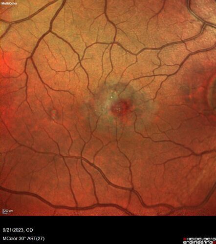 Macular Telangetasia MacTel - Nonproliferative
60 year old non-diabetic female with gradual vision loss for 20 years.  VA 20/80 OD, 20/63 OS
