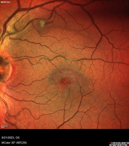 Macular Telangetasia MacTel - Nonproliferative
60 year old non-diabetic female with gradual vision loss for 20 years.  VA 20/80 OD, 20/63 OS
