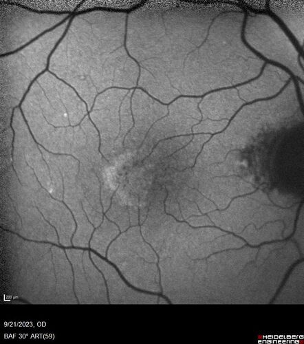 Macular Telangetasia MacTel - Nonproliferative
60 year old non-diabetic female with gradual vision loss for 20 years.  VA 20/80 OD, 20/63 OS

