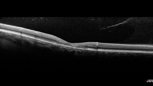 Macular Telangetasia MacTel - Nonproliferative
60 year old non-diabetic female with gradual vision loss for 20 years.  VA 20/80 OD, 20/63 OS
