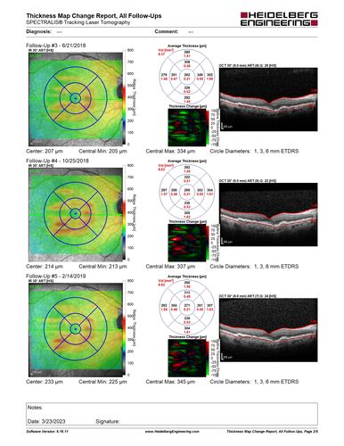 Non-exudative neovascular AMD right eye
Vision 20/20 at 6 year follow-up - no exudation
