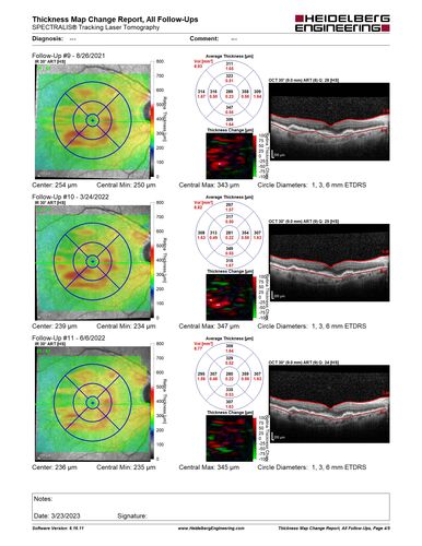 Non-exudative neovascular AMD right eye
Vision 20/20 at 6 year follow-up - no exudation

