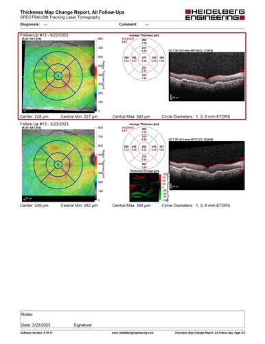 Non-exudative neovascular AMD right eye
Vision 20/20 at 6 year follow-up - no exudation
