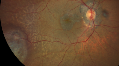 Melanosis Oculi and Choroidal Melanoma
88 year old female with 2.5 mm elevated choroidal melanoma and melanosis oculi.  She also has geographic atrophy from AMD.  The right eye is the better eye with 20/40 vision.  After observation with growth, brachytherapy was done.
