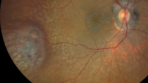 Melanosis Oculi and Choroidal Melanoma
88 year old female with 2.5 mm elevated choroidal melanoma and melanosis oculi.  She also has geographic atrophy from AMD.  The right eye is the better eye with 20/40 vision.  After observation with growth, brachytherapy was done.
