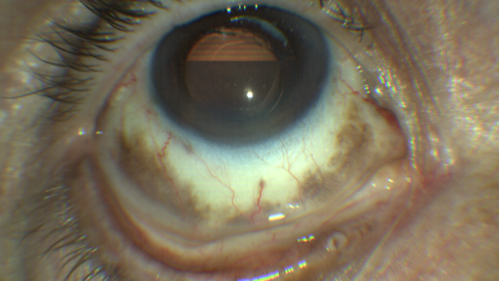 Melanosis Oculi and Choroidal Melanoma
88 year old female with 2.5 mm elevated choroidal melanoma and melanosis oculi.  She also has geographic atrophy from AMD.  The right eye is the better eye with 20/40 vision.  After observation with growth, brachytherapy was done.
