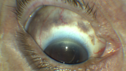 Melanosis Oculi and Choroidal Melanoma
88 year old female with 2.5 mm elevated choroidal melanoma and melanosis oculi.  She also has geographic atrophy from AMD.  The right eye is the better eye with 20/40 vision.  After observation with growth, brachytherapy was done.

