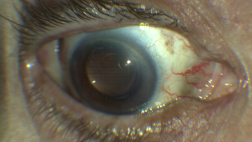 Melanosis Oculi and Choroidal Melanoma
88 year old female with 2.5 mm elevated choroidal melanoma and melanosis oculi.  She also has geographic atrophy from AMD.  The right eye is the better eye with 20/40 vision.  After observation with growth, brachytherapy was done.
