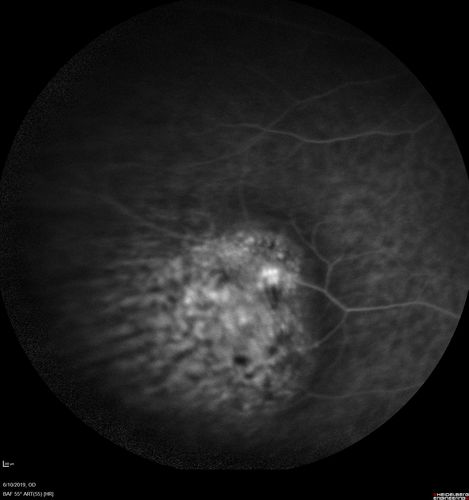 Melanosis Oculi and Choroidal Melanoma
88 year old female with 2.5 mm elevated choroidal melanoma and melanosis oculi.  She also has geographic atrophy from AMD.  The right eye is the better eye with 20/40 vision.  After observation with growth, brachytherapy was done.
