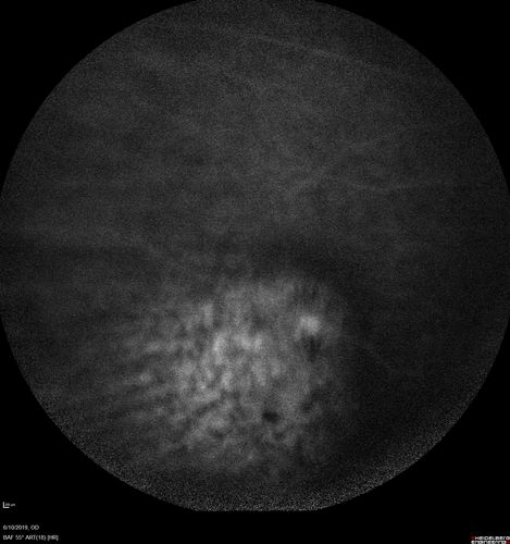 Melanosis Oculi and Choroidal Melanoma
88 year old female with 2.5 mm elevated choroidal melanoma and melanosis oculi.  She also has geographic atrophy from AMD.  The right eye is the better eye with 20/40 vision.  After observation with growth, brachytherapy was done.
