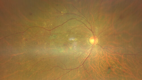 Severe NPDR with non-perfusion on FA
64 year old man with 20/32 vision in both eyes and mild blurring.  FA shows non-perfusion but no proliferation
