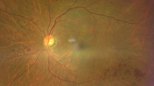 Severe NPDR with non-perfusion on FA
64 year old man with 20/32 vision in both eyes and mild blurring.  FA shows non-perfusion but no proliferation
