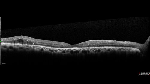 Severe NPDR with non-perfusion on FA
64 year old man with 20/32 vision in both eyes and mild blurring.  FA shows non-perfusion but no proliferation
