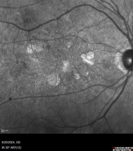 Severe NPDR with non-perfusion on FA
64 year old man with 20/32 vision in both eyes and mild blurring.  FA shows non-perfusion but no proliferation
