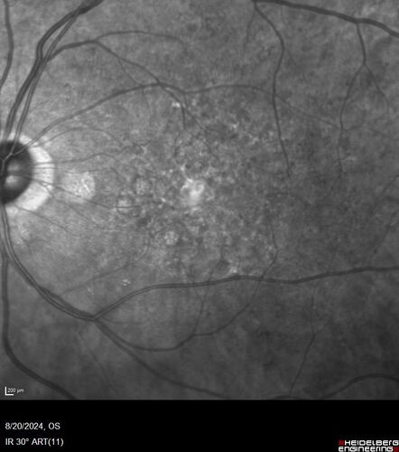 Severe NPDR with non-perfusion on FA
64 year old man with 20/32 vision in both eyes and mild blurring.  FA shows non-perfusion but no proliferation
