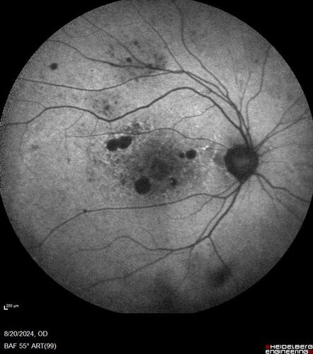 Severe NPDR with non-perfusion on FA
64 year old man with 20/32 vision in both eyes and mild blurring.  FA shows non-perfusion but no proliferation
