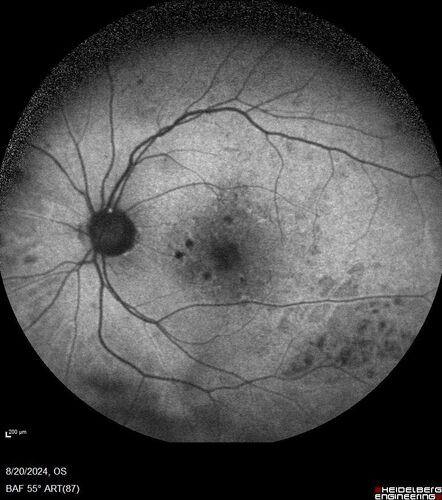 Severe NPDR with non-perfusion on FA
64 year old man with 20/32 vision in both eyes and mild blurring.  FA shows non-perfusion but no proliferation
