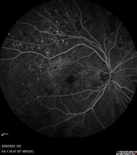 Severe NPDR with non-perfusion on FA
64 year old man with 20/32 vision in both eyes and mild blurring.  FA shows non-perfusion but no proliferation
