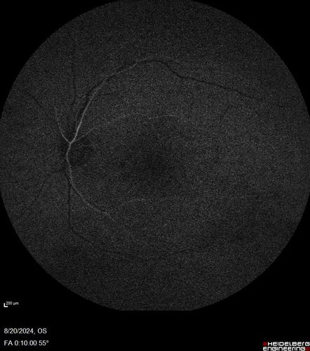Severe NPDR with non-perfusion on FA
64 year old man with 20/32 vision in both eyes and mild blurring.  FA shows non-perfusion but no proliferation
