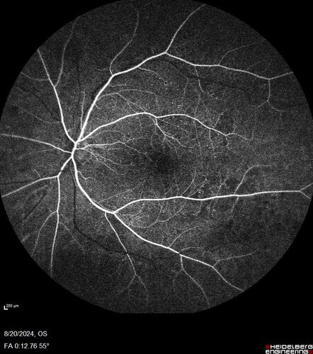 Severe NPDR with non-perfusion on FA
64 year old man with 20/32 vision in both eyes and mild blurring.  FA shows non-perfusion but no proliferation
