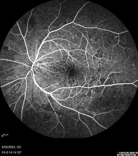 Severe NPDR with non-perfusion on FA
64 year old man with 20/32 vision in both eyes and mild blurring.  FA shows non-perfusion but no proliferation
