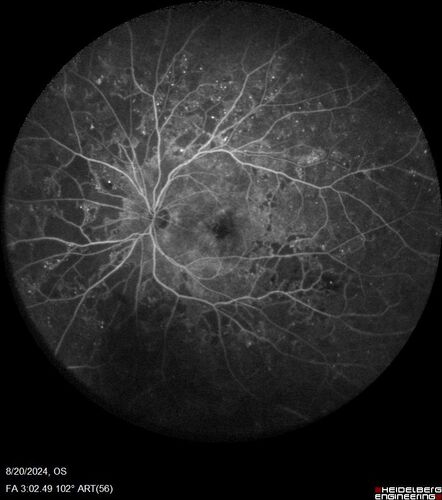 Severe NPDR with non-perfusion on FA
64 year old man with 20/32 vision in both eyes and mild blurring.  FA shows non-perfusion but no proliferation
