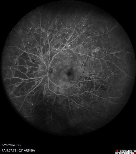 Severe NPDR with non-perfusion on FA
64 year old man with 20/32 vision in both eyes and mild blurring.  FA shows non-perfusion but no proliferation
