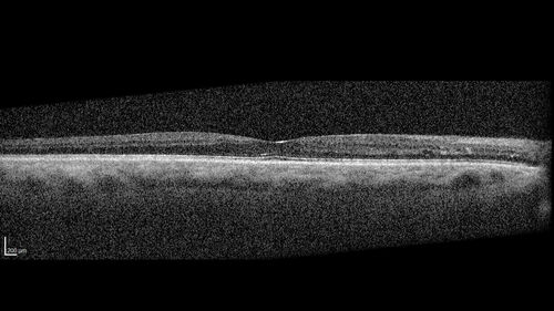 Severe NPDR
53 year old man with blurred vision (needs glasses).
Diabetic for 10 years with poor control
VA 20/32 OU
