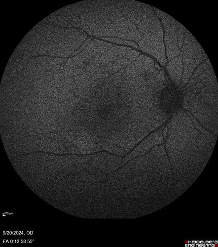 Severe NPDR
53 year old man with blurred vision (needs glasses).
Diabetic for 10 years with poor control
VA 20/32 OU
