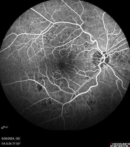 Severe NPDR
53 year old man with blurred vision (needs glasses).
Diabetic for 10 years with poor control
VA 20/32 OU
