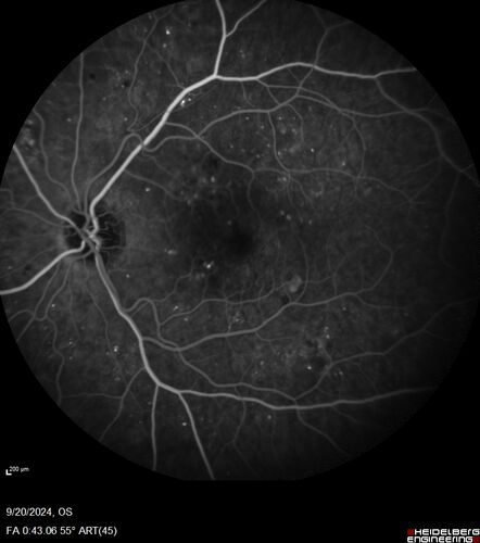 Severe NPDR
53 year old man with blurred vision (needs glasses).
Diabetic for 10 years with poor control
VA 20/32 OU
