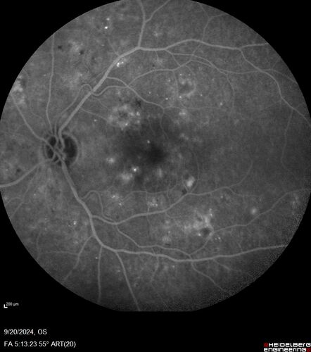 Severe NPDR
53 year old man with blurred vision (needs glasses).
Diabetic for 10 years with poor control
VA 20/32 OU
