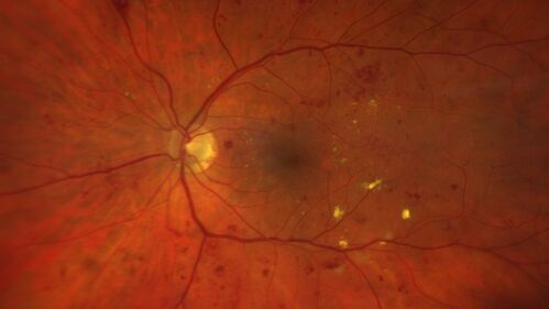 Nonproliferative Diabetic Retinopathy and Good Vision
59 year old man Vision is good.  Just referred following annual eye examination
PMHx: Type II DM, HTN, Cholesterol, 
MEDS: Lantus, Metformin, lisinopril, atorvastatin, gabapentin

VA 20/20 OU
2+ NS OU

Observation
