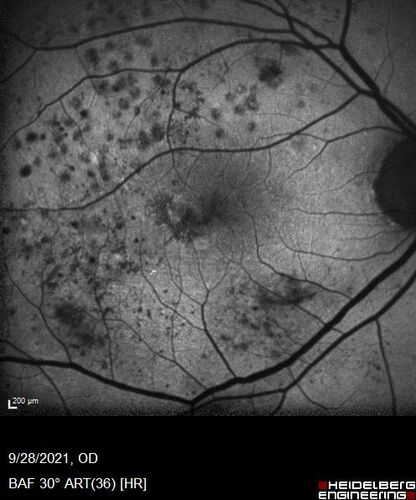Nonproliferative Diabetic Retinopathy and Good Vision
59 year old man Vision is good.  Just referred following annual eye examination
PMHx: Type II DM, HTN, Cholesterol, 
MEDS: Lantus, Metformin, lisinopril, atorvastatin, gabapentin

VA 20/20 OU
2+ NS OU

Observation
