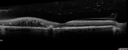 Nonproliferative Diabetic Retinopathy and Good Vision
59 year old man Vision is good.  Just referred following annual eye examination
PMHx: Type II DM, HTN, Cholesterol, 
MEDS: Lantus, Metformin, lisinopril, atorvastatin, gabapentin

VA 20/20 OU
2+ NS OU

Observation
