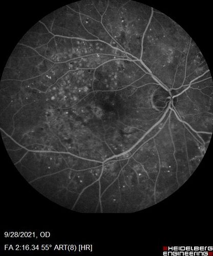 Nonproliferative Diabetic Retinopathy and Good Vision
59 year old man Vision is good.  Just referred following annual eye examination
PMHx: Type II DM, HTN, Cholesterol, 
MEDS: Lantus, Metformin, lisinopril, atorvastatin, gabapentin

VA 20/20 OU
2+ NS OU

Observation
