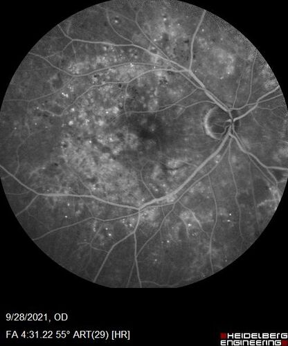 Nonproliferative Diabetic Retinopathy and Good Vision
59 year old man Vision is good.  Just referred following annual eye examination
PMHx: Type II DM, HTN, Cholesterol, 
MEDS: Lantus, Metformin, lisinopril, atorvastatin, gabapentin

VA 20/20 OU
2+ NS OU

Observation
