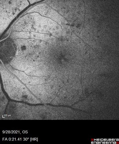 Nonproliferative Diabetic Retinopathy and Good Vision
59 year old man Vision is good.  Just referred following annual eye examination
PMHx: Type II DM, HTN, Cholesterol, 
MEDS: Lantus, Metformin, lisinopril, atorvastatin, gabapentin

VA 20/20 OU
2+ NS OU

Observation
