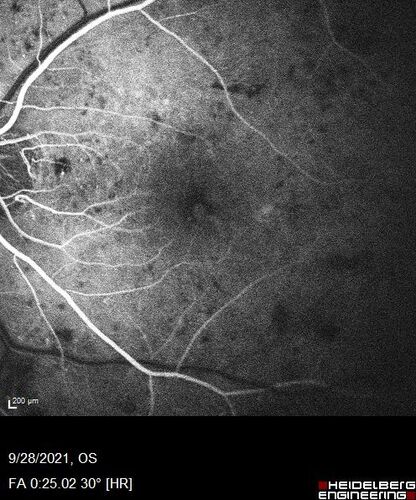 Nonproliferative Diabetic Retinopathy and Good Vision
59 year old man Vision is good.  Just referred following annual eye examination
PMHx: Type II DM, HTN, Cholesterol, 
MEDS: Lantus, Metformin, lisinopril, atorvastatin, gabapentin

VA 20/20 OU
2+ NS OU

Observation
