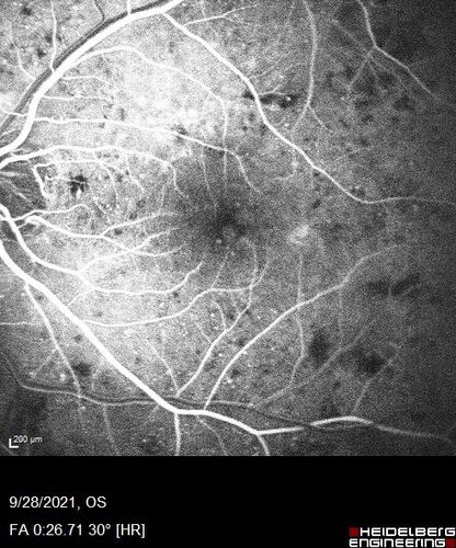 Nonproliferative Diabetic Retinopathy and Good Vision
59 year old man Vision is good.  Just referred following annual eye examination
PMHx: Type II DM, HTN, Cholesterol, 
MEDS: Lantus, Metformin, lisinopril, atorvastatin, gabapentin

VA 20/20 OU
2+ NS OU

Observation
