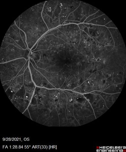 Nonproliferative Diabetic Retinopathy and Good Vision
59 year old man Vision is good.  Just referred following annual eye examination
PMHx: Type II DM, HTN, Cholesterol, 
MEDS: Lantus, Metformin, lisinopril, atorvastatin, gabapentin

VA 20/20 OU
2+ NS OU

Observation

