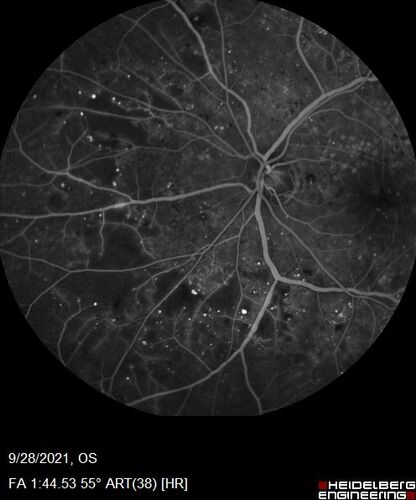 Nonproliferative Diabetic Retinopathy and Good Vision
59 year old man Vision is good.  Just referred following annual eye examination
PMHx: Type II DM, HTN, Cholesterol, 
MEDS: Lantus, Metformin, lisinopril, atorvastatin, gabapentin

VA 20/20 OU
2+ NS OU

Observation
