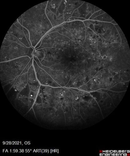Nonproliferative Diabetic Retinopathy and Good Vision
59 year old man Vision is good.  Just referred following annual eye examination
PMHx: Type II DM, HTN, Cholesterol, 
MEDS: Lantus, Metformin, lisinopril, atorvastatin, gabapentin

VA 20/20 OU
2+ NS OU

Observation
