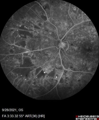 Nonproliferative Diabetic Retinopathy and Good Vision
59 year old man Vision is good.  Just referred following annual eye examination
PMHx: Type II DM, HTN, Cholesterol, 
MEDS: Lantus, Metformin, lisinopril, atorvastatin, gabapentin

VA 20/20 OU
2+ NS OU

Observation
