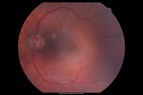 Proliferative Diabetic Retinopathy - NVD regressed with PRP laser
76 year old diabetic man - Presented one year ago with NVD in the left eye.  This regressed with laser but then a year later worsened.  Additional PRP was done and the NVD regressed again.

