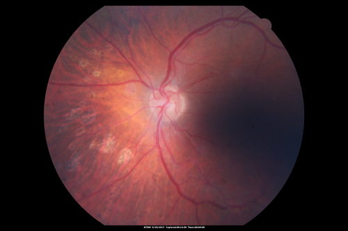 Proliferative Diabetic Retinopathy - NVD regressed with PRP laser
76 year old diabetic man - Presented one year ago with NVD in the left eye.  This regressed with laser but then a year later worsened.  Additional PRP was done and the NVD regressed again.
