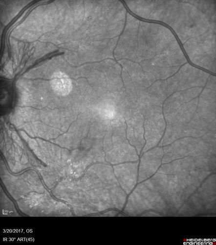 Proliferative Diabetic Retinopathy - NVD regressed with PRP laser
76 year old diabetic man - Presented one year ago with NVD in the left eye.  This regressed with laser but then a year later worsened.  Additional PRP was done and the NVD regressed again.
